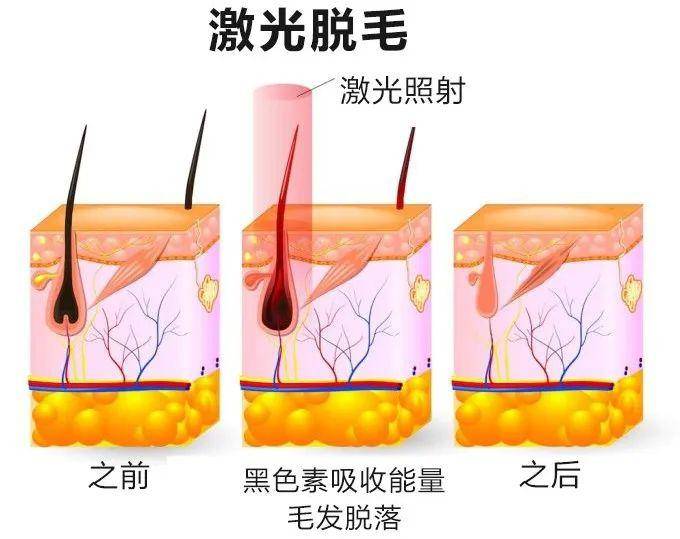 脸上的汗毛很长很多怎么办？蜜蜡脱毛的作用